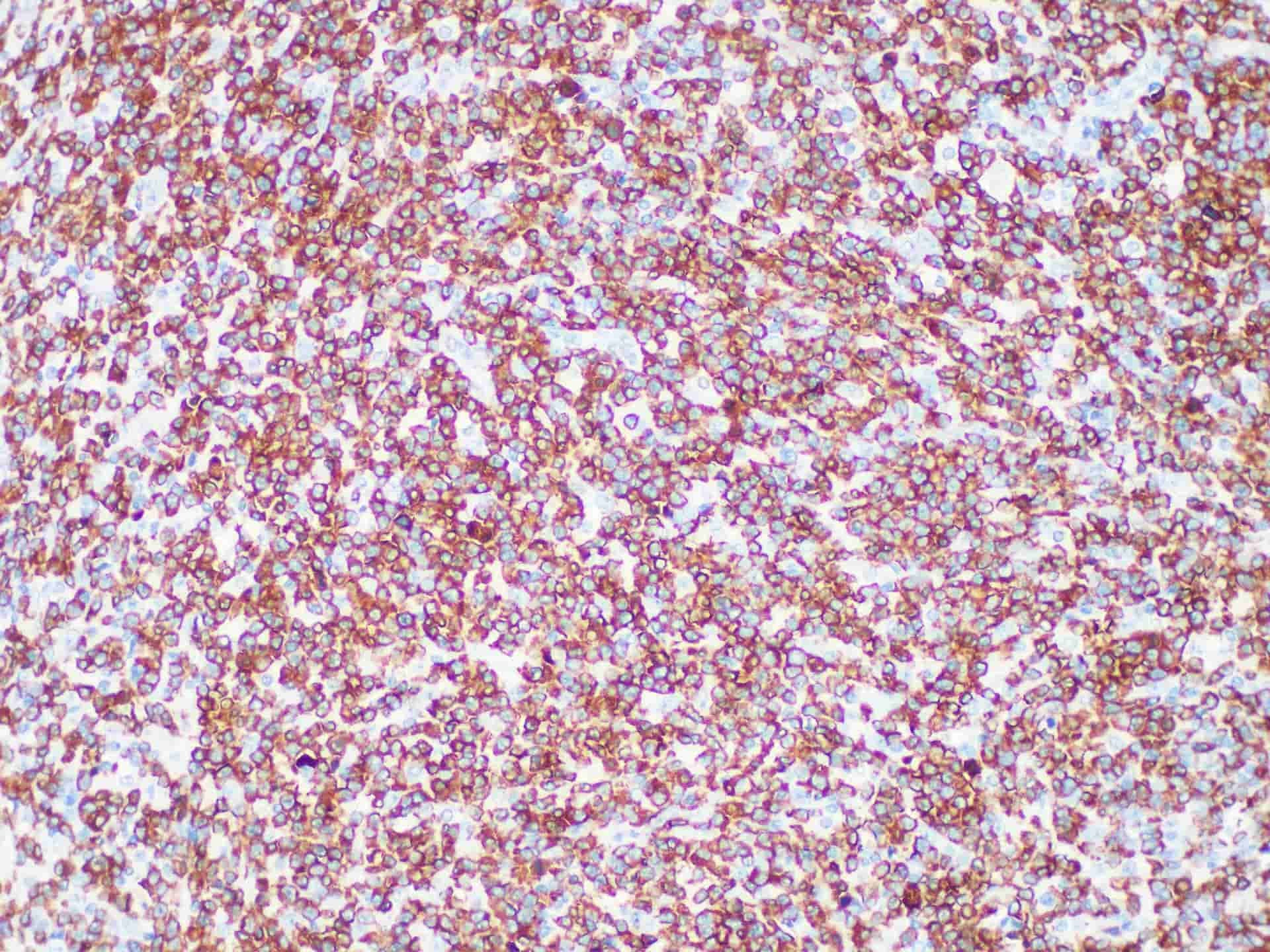 ALK Monoclonal Antibody Synonyms ALK