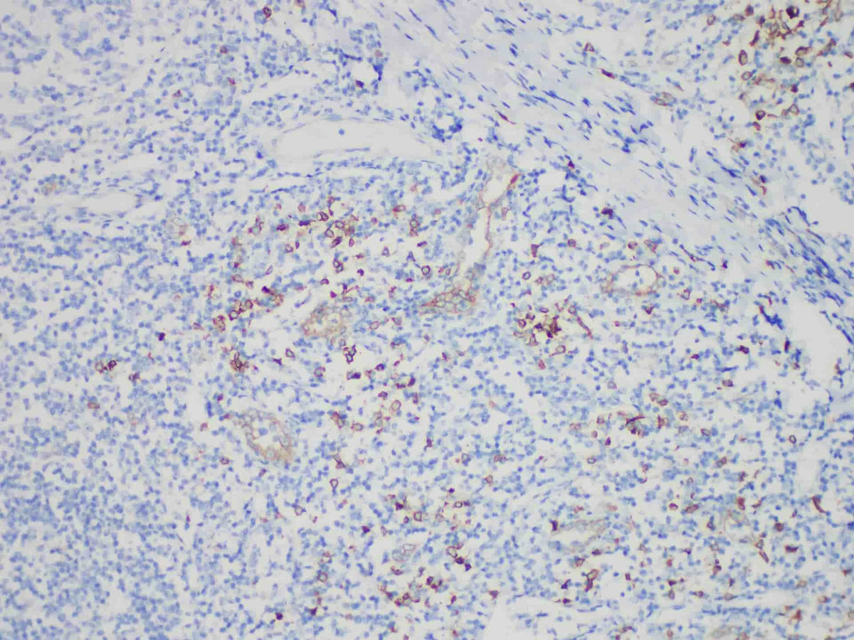 CD123 Monoclonal Antibody Stored at -20°C