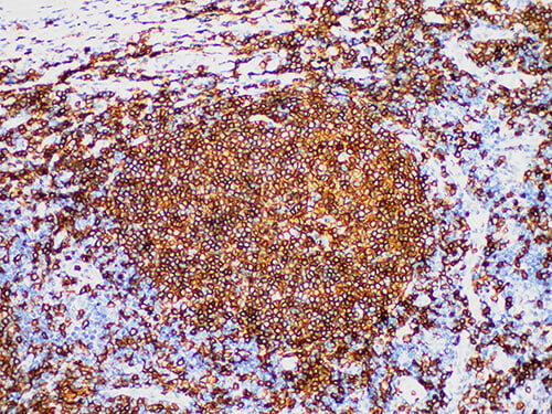 CD20 Monoclonal Antibody Stored at -20°C