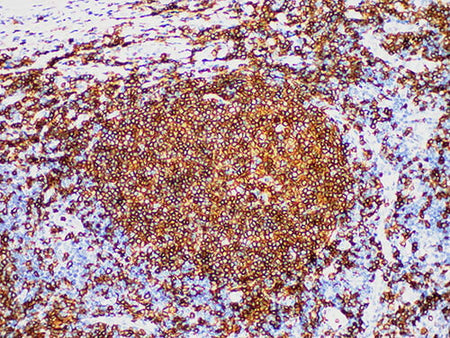 CD20 Monoclonal Antibody Stored at -20°C
